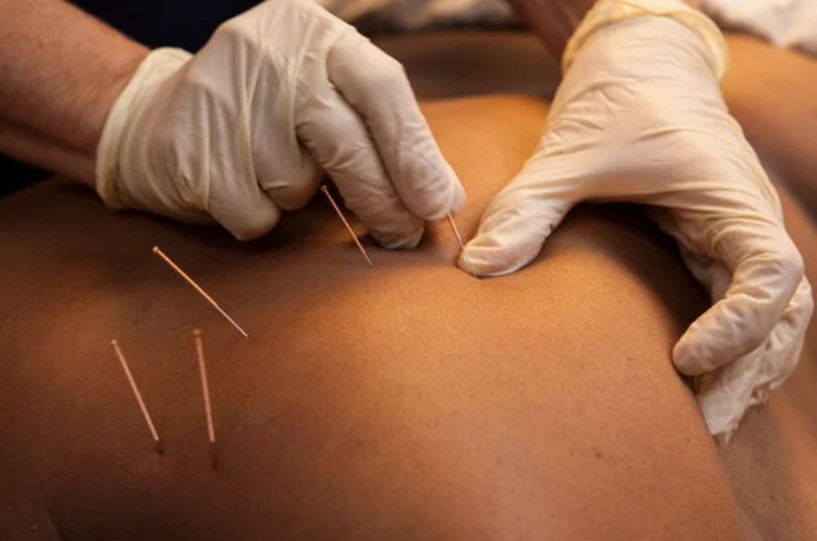 Dry Needling---01